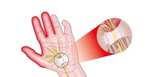 Schmerzen in den Fingergelenken mit Rhizarthrose