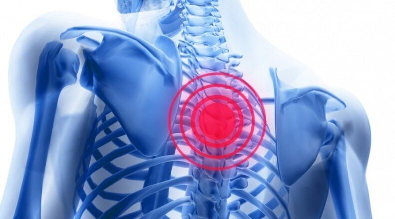 Rückenschmerzen können mit einem Bandscheibenvorfall verbunden sein
